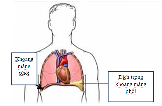 Hội chứng tràn dịch màng phổi là gì?