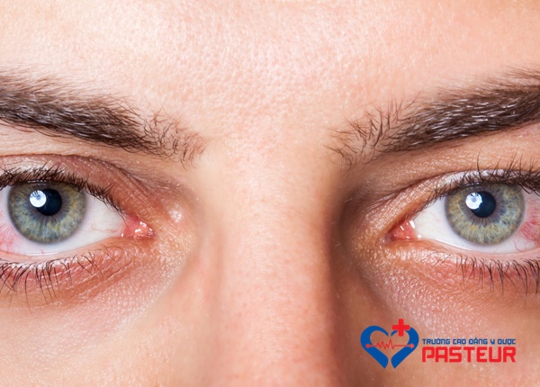 Hội chứng khô mắt có nguy hiểm không?