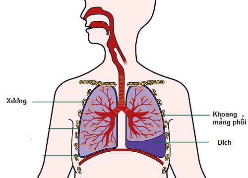 Bệnh án nội khoa tràn dịch màng phổi