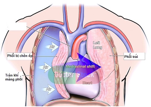 Bệnh án nội khoa tràn khí màng phổi