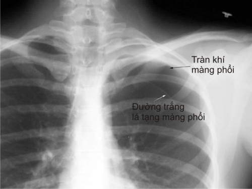  Hình ảnh trong bệnh án nội khoa tràn khí màng phổi