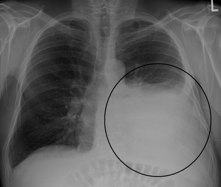 Xquang- hội chứng tràn dịch màng phổi