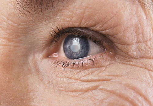 Đục thủy tinh thể là căn bệnh thường gặp ở người cao tuổi