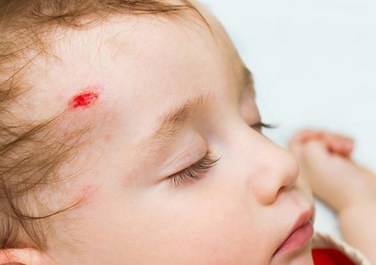 Dấu hiệu giúp phát hiện chấn thương sọ não ở trẻ em