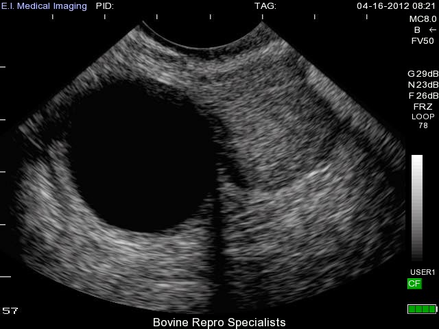 Hình ảnh siêu âm u nang buồng trứng