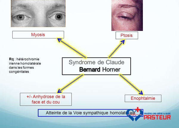 Nguyên nhân gây ra hội chứng liệt giao cảm Horner-Bernard